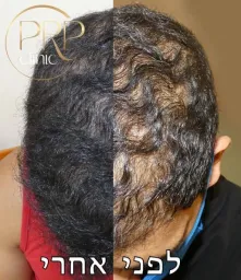 PRP Clinic